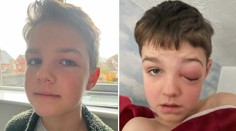 Len deväťročný chlapec po infikovaní sa covidom prežíval muky. Takmer prišiel o oko