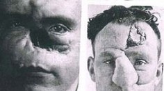 Prvé plastiky na svete dopadli katastrofálne! Niektorým znetvorili tvár ešte viac