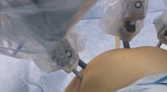 Unikátne operácie v Roosveltovej nemocnici: Pacienti s rakovinou majú novú nádej