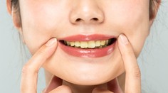 Žlté, fialové až čierne. Čo znamená, ak majú vaše zuby inú farbu ako bielu