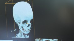 Ukázali technológie, ktoré majú zlepšiť slovenské zdravotníctvo. Niektoré vás prekvapia