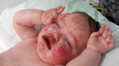 Chlapčekovi šlo o život. Katastrofálna reakcia na liek s obsahom ibuprofénu