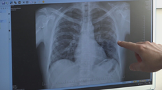 Seniorke pomohla zachrániť život umelá inteligencia. Nástroj jej odhalil nádor na pľúcach