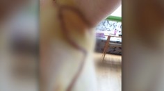 Z drobnej vyrážky sa stal boj o normálny život. Žena nedokázala dvihnúť ruky, lekári ju zachránili v hodine dvanástej