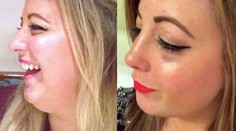 Chcela dokonalú selfie. Na plastiky tak minula hotový majetok