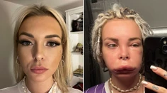 Veronika má vzácne dedičné ochorenie. Opúcha jej tvár či ruky a nikdy nevie, kedy to príde