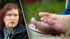 Ani sedem rokov po operácii haluxov sa Márii stav nezlepšil. Odporúčajú jej amputáciu