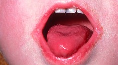 Po celom Slovensku sa šíri šarlach. Hygienici ale ubezpečujú rodičov, že nie je dôvod na paniku