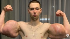 Ruský "Pepek námorník" prišiel o syntholové bicepsy. Podľa chirurga mal obrovské štastie