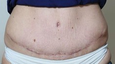 Chcela ušetriť na plastike brucha. V Poľsku ju takto znetvorili!