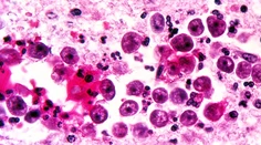 „Mozgožravá“ améba znovu zabíjala: Žena mala mimoriadne nepríjemné príznaky
