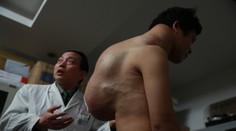 Muž žije s 10-kilovým nádorom na chrbte. Podstúpil riskantnú operáciu