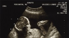 Súd v Salvadore poslal mladú ženu na 30 rokov do väzenia za spontánny potrat