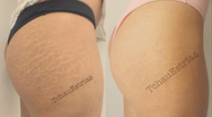 Takto by vám asi nenapadlo zbaviť sa strií. Nová metóda však naozaj funguje