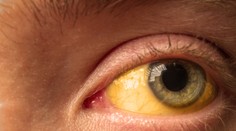 Lekárov znepokojuje nárast žltačky u detí. Na vine by mohol byť tento vírus