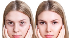 Trápia vás kruhy pod očami? Takto s nimi zatočíte