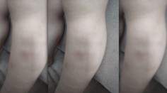 Dieťa (1) údajne počas injekcie zviazali, teraz má modriny: Nemocnica už prípad prešetruje