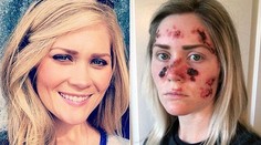 Chodila do solária, teraz bojuje s rakovinou kože