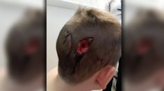 Brutálny útok psov. Chlapec (8) skončil s poranenou lebkou a hlbokou ranou