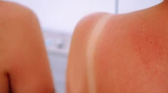 Kyslá smotana na spálenú pokožku? Určite nie, môže spôsobiť infekciu, tvrdí odborníčka