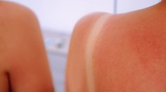 Kyslá smotana na spálenú pokožku? Určite nie, môže spôsobiť infekciu, tvrdí odborníčka