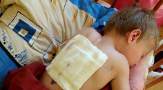Dieťa s odreninami a popáleninami. Učiteľka vraj stratila nervy