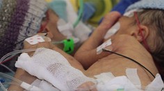 Najmenšie oddelené siamské dvojičky na svete. Mali len osem dní