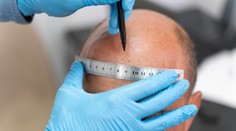 Zákrok za zlomok ceny sa zmenil na horor. Muž zomrel počas transplantácie vlasov v Turecku