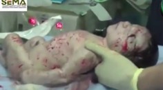 Zázrak. Tehotnej žene po výbuchu bomby v Sýrii vybrali zranené dieťa