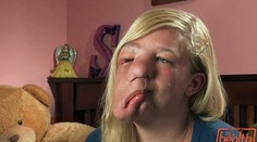 Dievča žije s obrovským nádorom na hlave. Okolie sa jej vysmieva