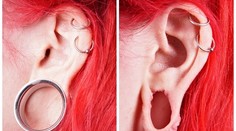 Tunel v uchu. Pre mnohých módny trend, o pár rokov neskôr drahá komplikácia!