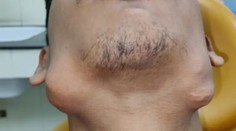 Pre nádor mu narástlo 82 zubov. Teraz sa dočkal vytúženej operácie