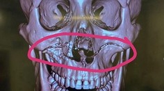 VIDEO: Ragbista utrpel hororové zranenie. Po zrážke hlavami si odtrhol celú čeľusť