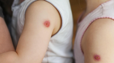 Indiou sa šíri vysoko nákazlivé ochorenie. Pľuzgier podobný paradajke zatiaľ ohrozuje iba deti