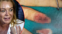 Lindsay Lohan zverejnila snímky, ako jej prišívali odseknutý prst