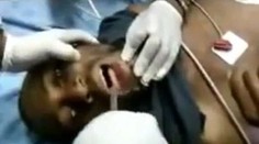 Neuveriteľný moment, kedy lekár vytiahol mužovi z úst mobil