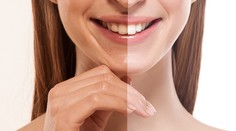 Trendy, ktoré sľubujú žiarivý úsmev. Skutočne fungujú?