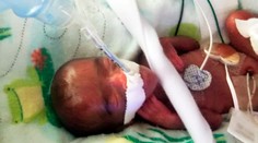 Najmenšie porodené dieťa na svete prežilo. Lekári mu dávali po pôrode hodinu