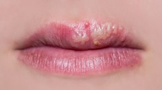 Dr. Bukovský vyvrátil mýtus o liečbe herpesu vajíčkom