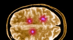 Vedci poukázali na nenápadný príznak sklerózy multiplex. Objavuje sa 15 rokov pred prepuknutím choroby