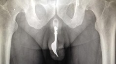 Vidlička v penise, pôrod v škole, ale aj neúspešná samovražda