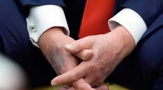 Obavy o zdravotný stav Trumpa: Prezident sa pravidelne objavuje s veľkými modrinami. Biely dom má odpoveď