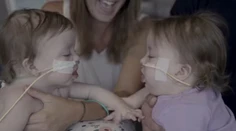 Lekári sa báli, že sa nemusia dožiť operácie. Teraz tieto siamské dvojičky úspešne oddelili