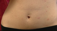 Zjavili sa vám na tele vyrážky? Nie ste jediní