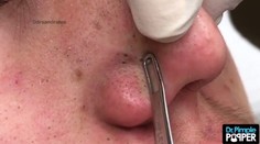 Videá vytláčania vyrážok sledujú milióny ľudí. Relaxujú pri tom