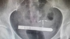 Pár si chcel spestriť romantické chvíle. Skončilo sa to bolestivými vibráciami v bruchu a operáciou