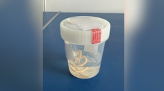 Tlak na hrudi či dýchavičnosť nemusia znamenať len problémy so srdcom. Klinika upozorňuje na kuriózny prípad