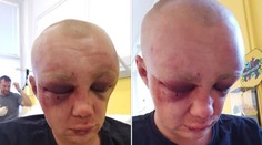 Mladého muža dokopali v Česku do bezvedomia. Praskla mu lebka