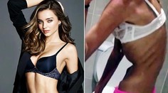 Chcela vyzerať ako Miranda Kerr. Dostala sa na váhu 30 kilogramov!