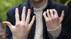 Herec nahradil chýbajúce prsty na rukách tými na nohe